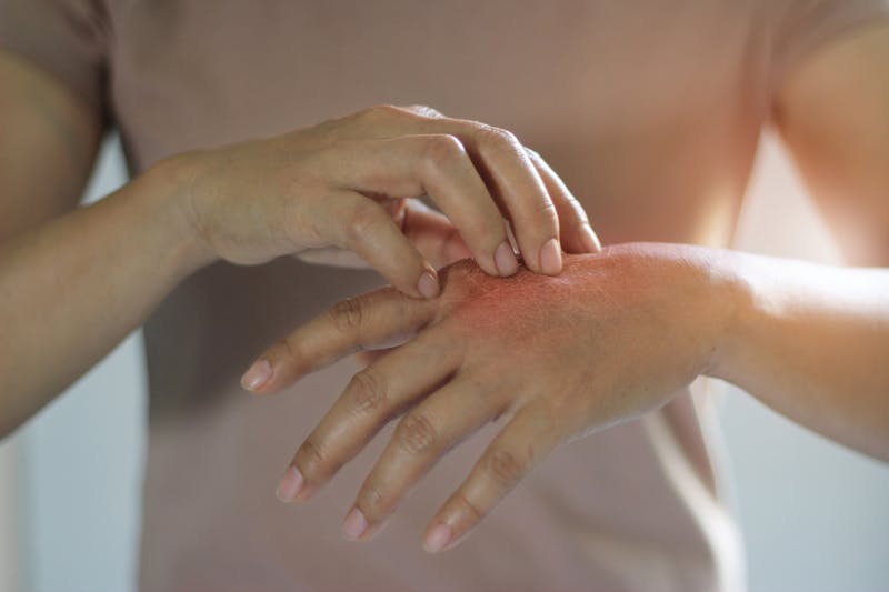woman touching rash on hand