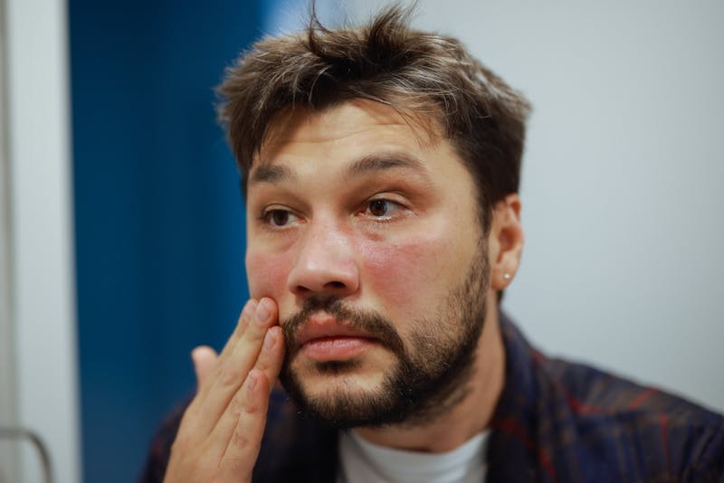 man with face rash