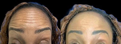 Botox Before & After Gallery - Patient 110041 - Image 1