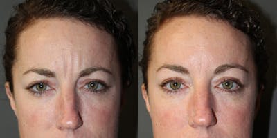 Botox Before & After Gallery - Patient 350252 - Image 1