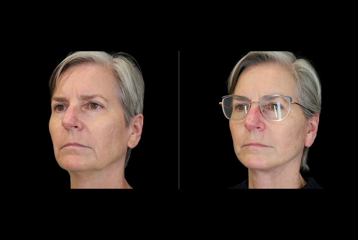 Facelift Before & After Gallery - Patient 275688 - Image 2