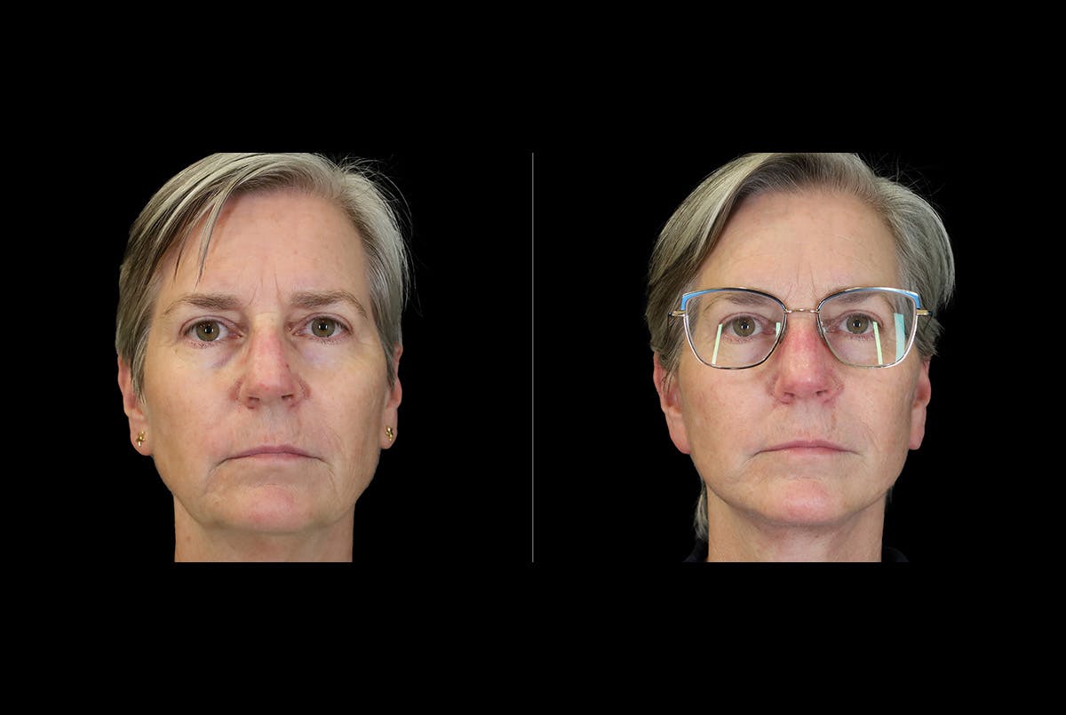 Facelift Before & After Gallery - Patient 275688 - Image 4