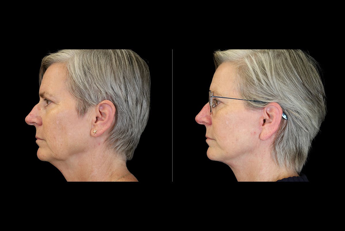 Facelift Before & After Gallery - Patient 275688 - Image 1