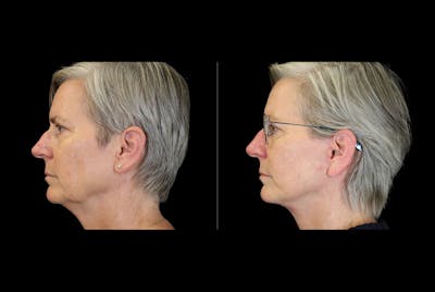 Facelift Before & After Gallery - Patient 275688 - Image 1