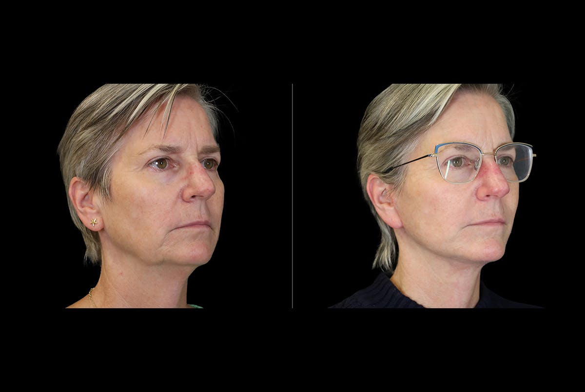Facelift Before & After Gallery - Patient 275688 - Image 3