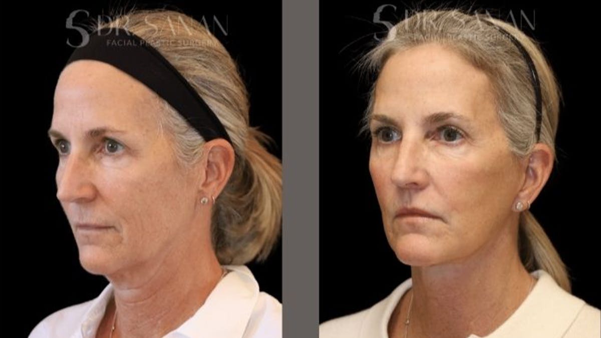 Deep Plane Facelift Before & After Gallery - Patient 155305 - Image 2