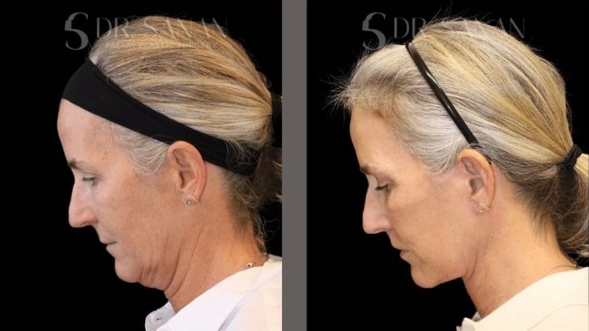 Deep Plane Facelift Before & After Gallery - Patient 155305 - Image 4