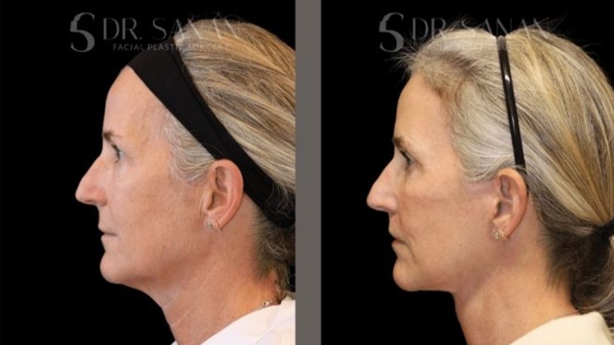 Deep Plane Facelift Before & After Gallery - Patient 155305 - Image 1