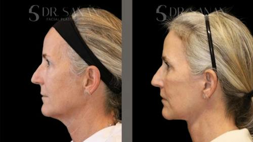 Before and after photos with Akshay Sanan, MD, FACS - patient 4 of 4