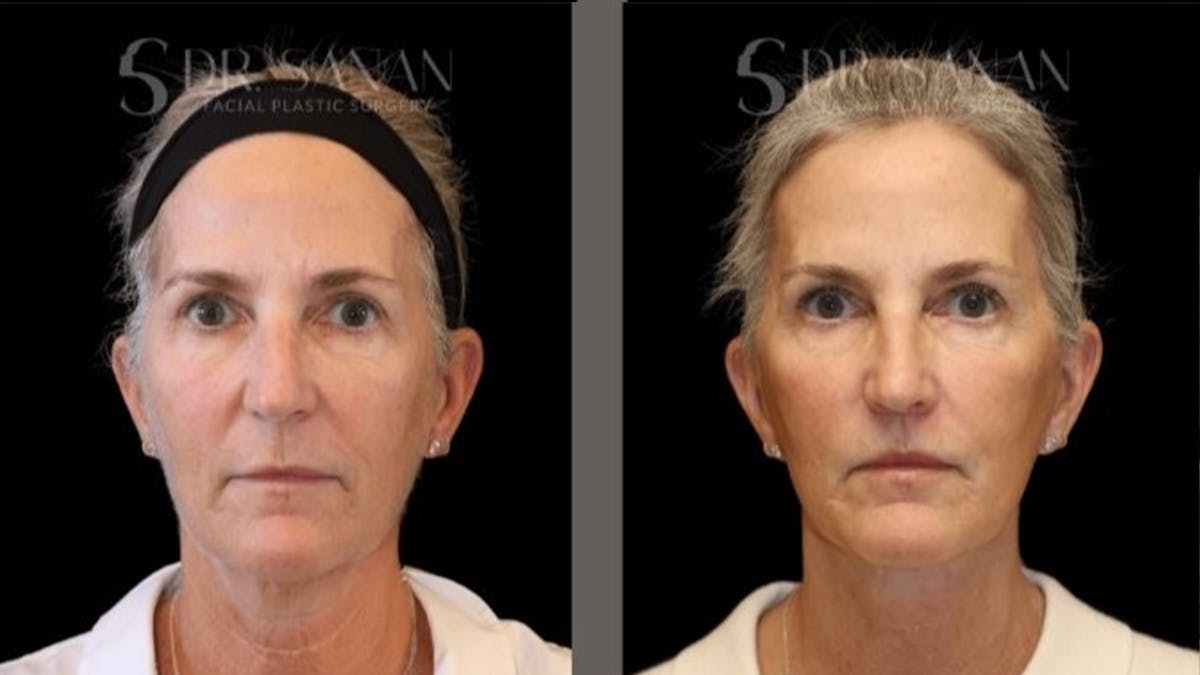 Deep Plane Facelift Before & After Gallery - Patient 155305 - Image 3