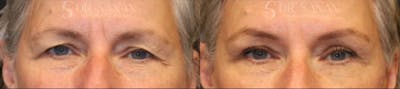 Blepharoplasty Before & After Gallery - Patient 918734 - Image 1