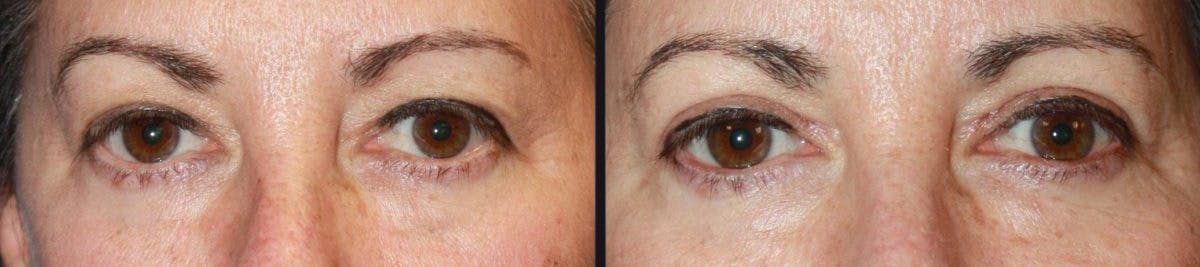 Blepharoplasty Before & After Gallery - Patient 176332 - Image 1