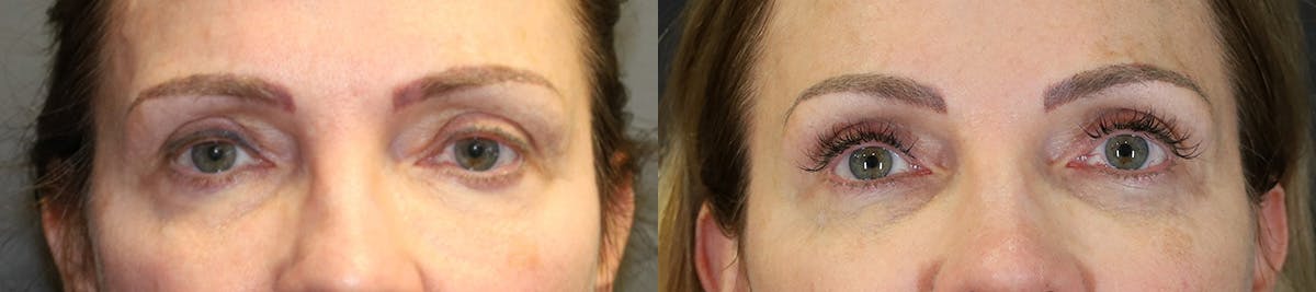 Blepharoplasty Before & After Gallery - Patient 139388 - Image 1
