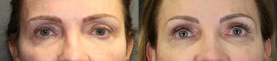 Blepharoplasty Before & After Gallery - Patient 139388 - Image 1