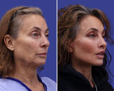 Facelift Before & After Gallery - Patient 211576 - Image 1
