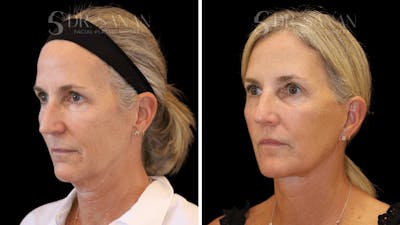 Facial Plastic Surgery Before & After Gallery - Patient 108924 - Image 1