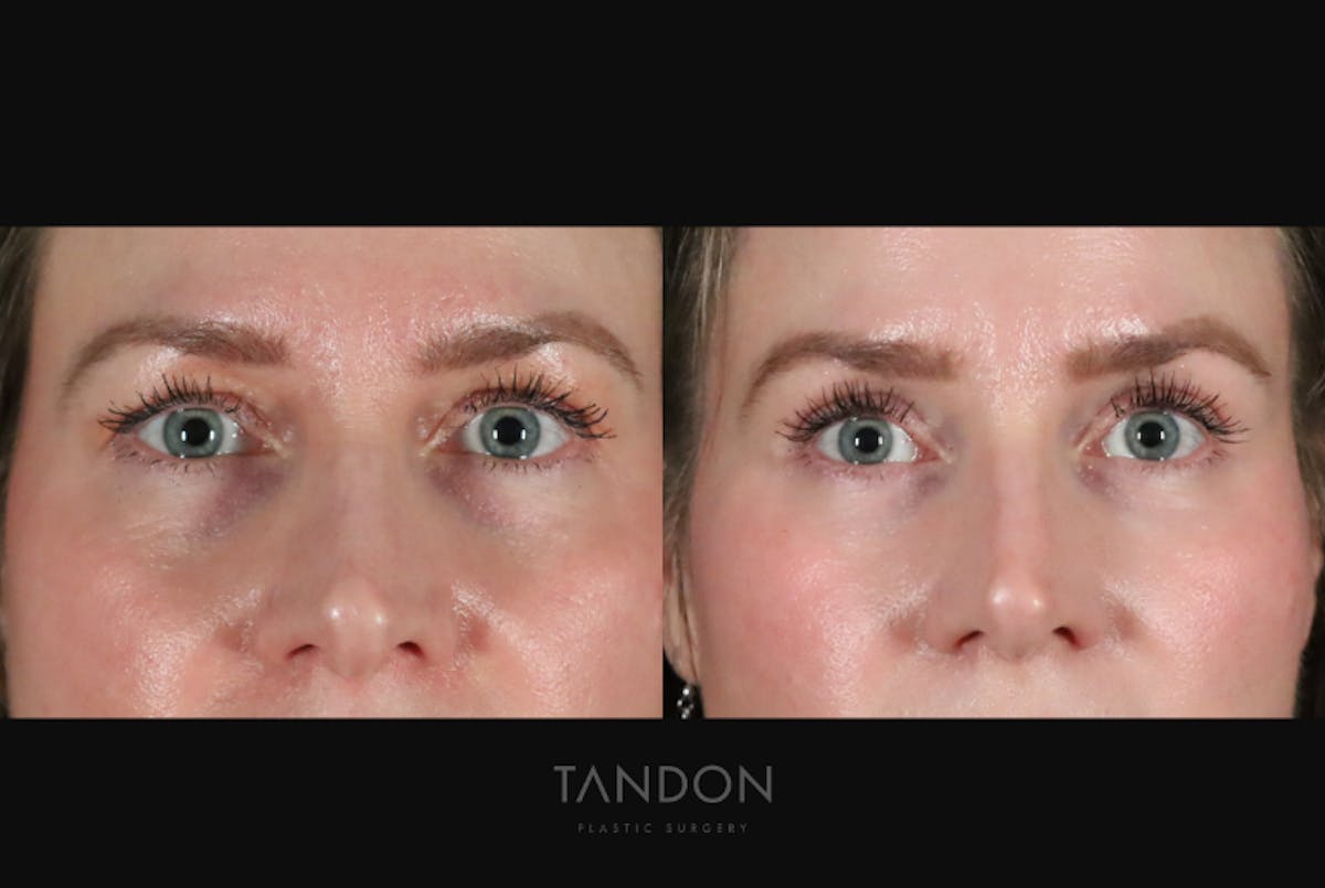 Facial Plastic Surgery Before & After Gallery - Patient 479954 - Image 1