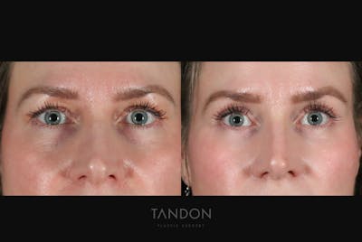 Facial Plastic Surgery Before & After Gallery - Patient 479954 - Image 1