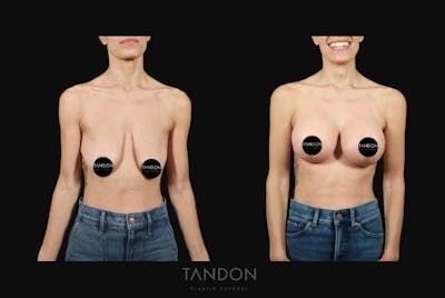 Breast Surgery Before & After Gallery - Patient 103368 - Image 1