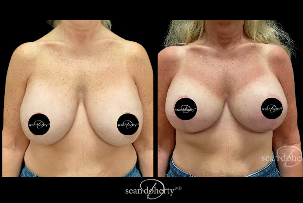 Breast Surgery Before & After Gallery - Patient 231066 - Image 1