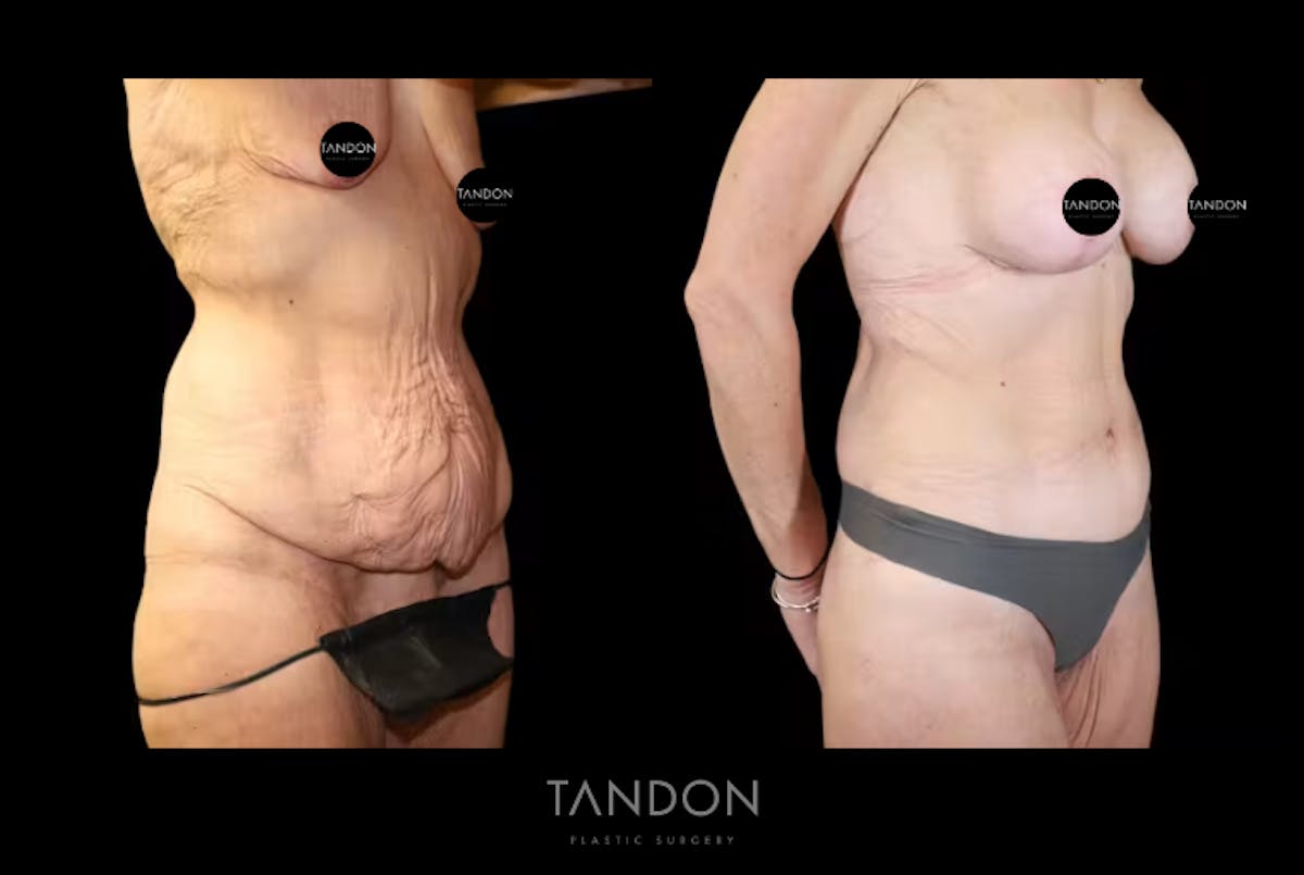 Body Plastic Surgery Before & After Gallery - Patient 733437 - Image 1