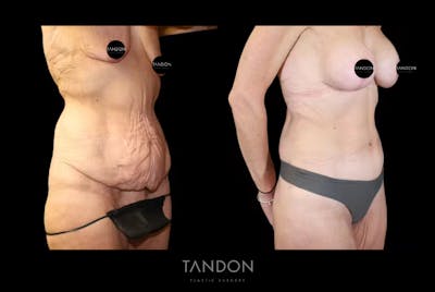 Body Plastic Surgery Before & After Gallery - Patient 733437 - Image 1