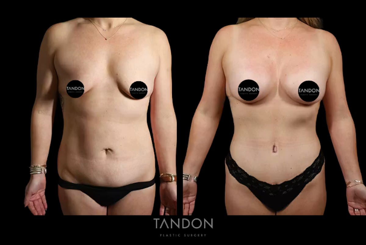 Body Plastic Surgery Before & After Gallery - Patient 406157 - Image 1