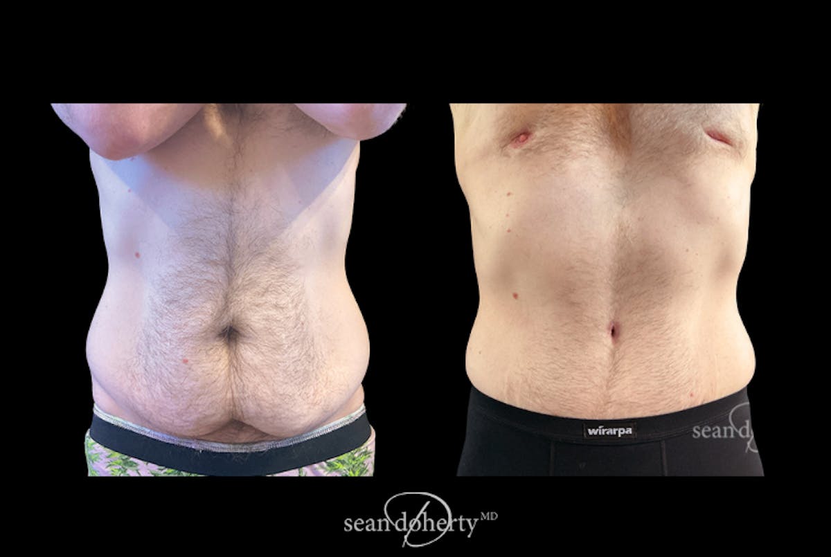 Body Plastic Surgery Before & After Gallery - Patient 361071 - Image 1