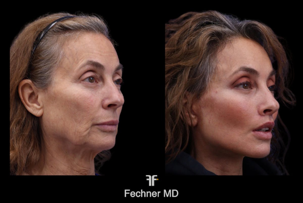 Facial Plastic Surgery Before & After Gallery - Patient 211576 - Image 1