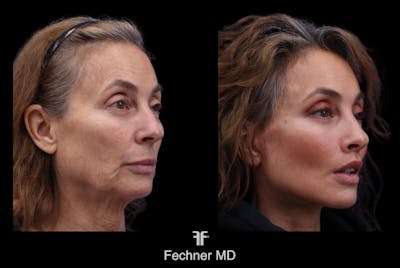 Facial Plastic Surgery Before & After Gallery - Patient 211576 - Image 1