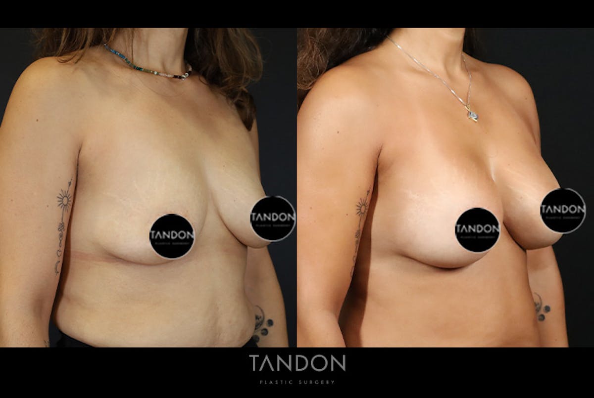 Breast Surgery Before & After Gallery - Patient 968165 - Image 2