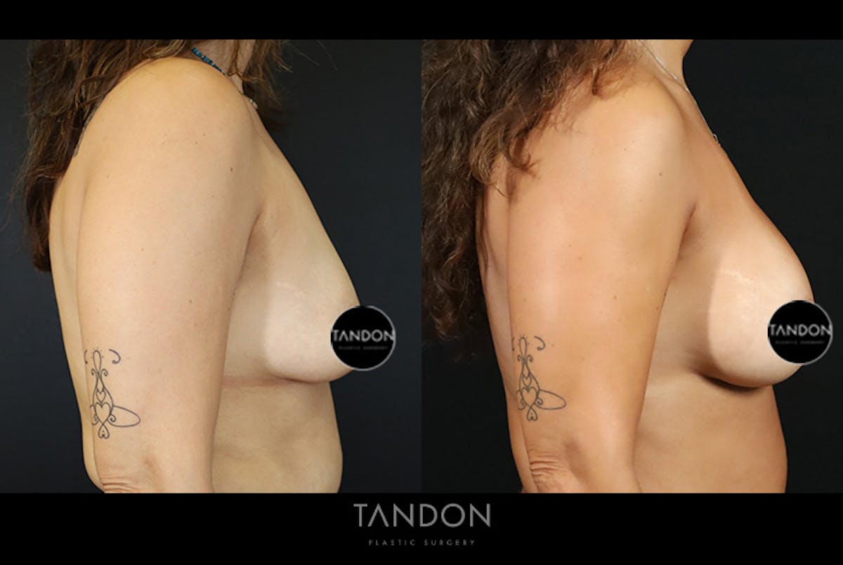 Breast Surgery Before & After Gallery - Patient 968165 - Image 3