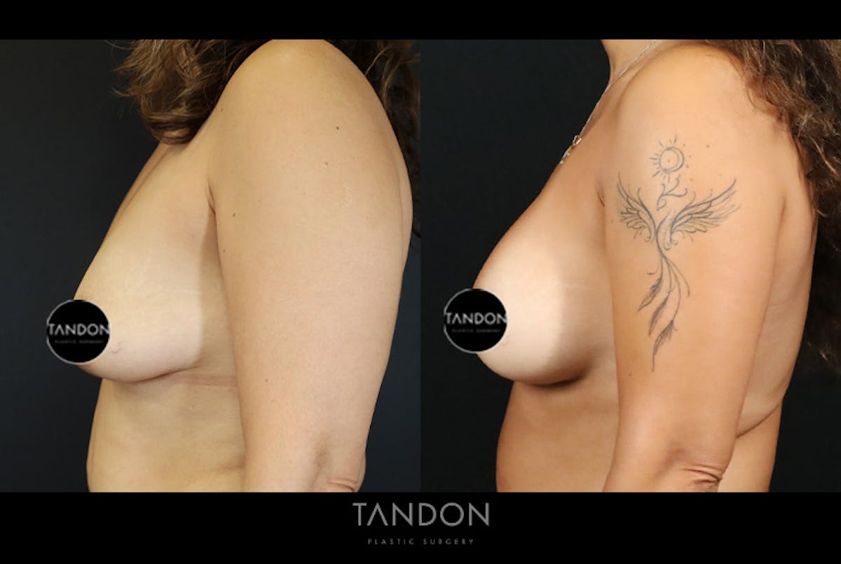 Breast Surgery Before & After Gallery - Patient 968165 - Image 5