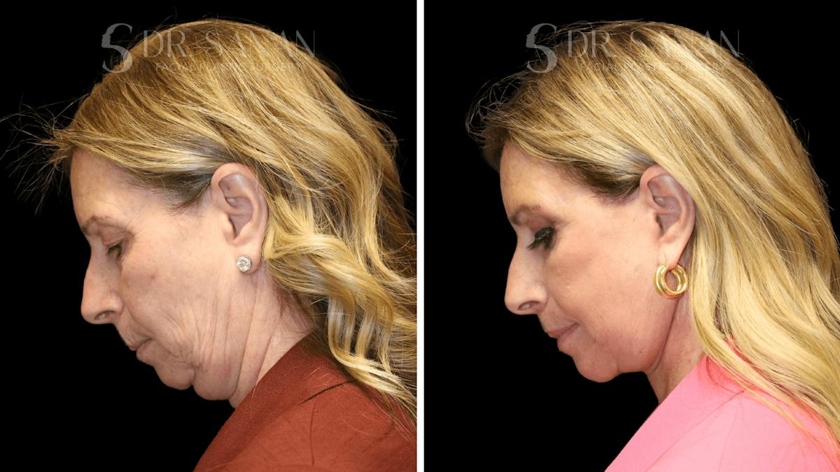 Sanan-Deep Plane Facelift Before & After Gallery - Patient 394283 - Image 5