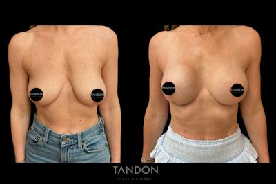 Tandon - Plastic Surgery Before & After Gallery - Patient 915888 - Image 1