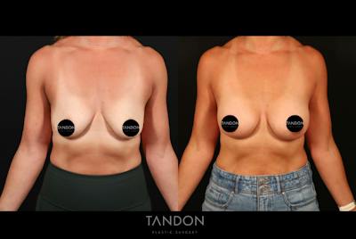 Tandon - Plastic Surgery Before & After Gallery - Patient 318883 - Image 1