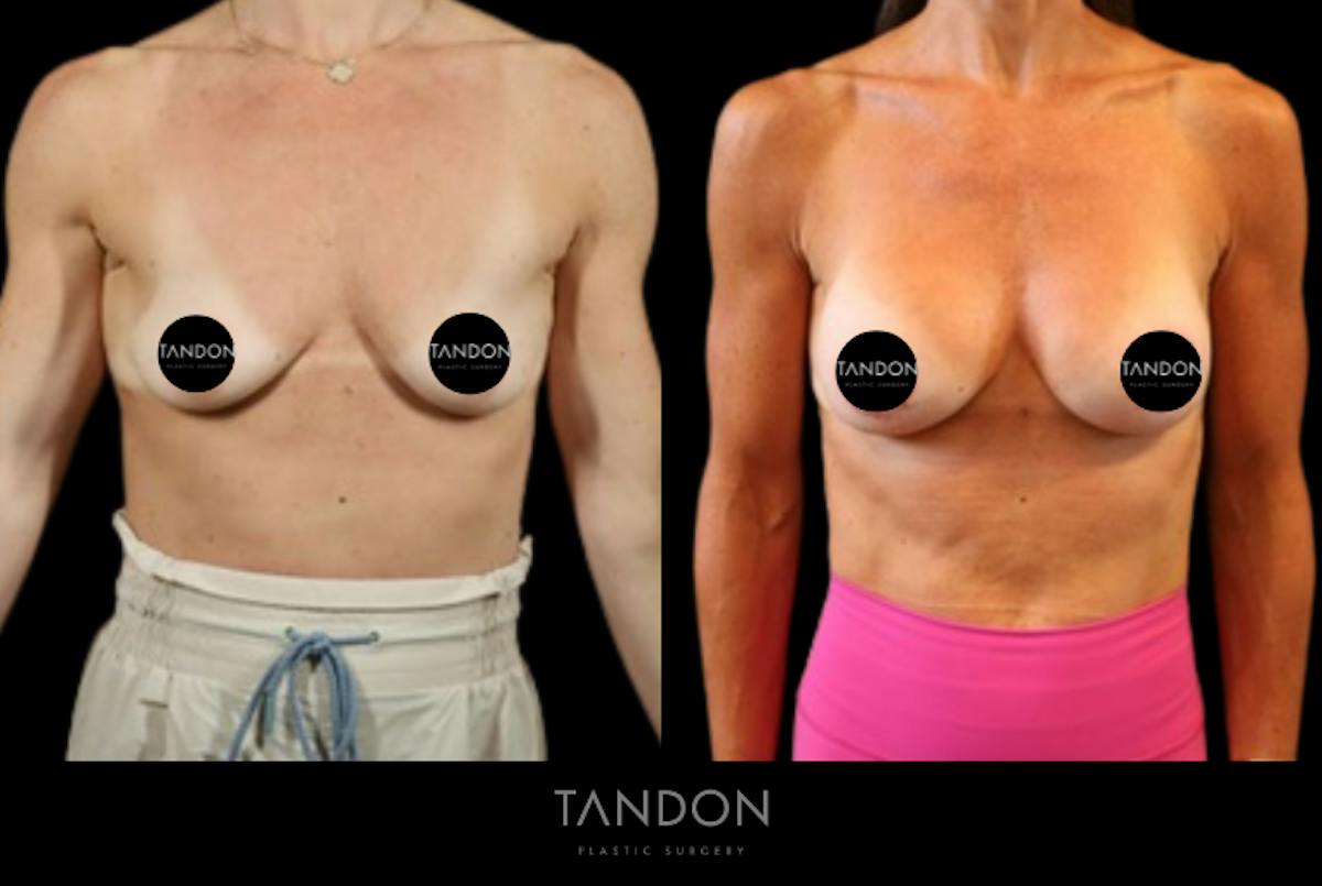 Tandon - Plastic Surgery Before & After Gallery - Patient 201227 - Image 1