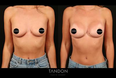 Tandon - Plastic Surgery Before & After Gallery - Patient 104394 - Image 1