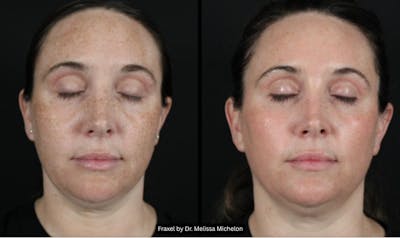 Michelon Non-surgical Before & After Gallery - Patient 578737 - Image 1