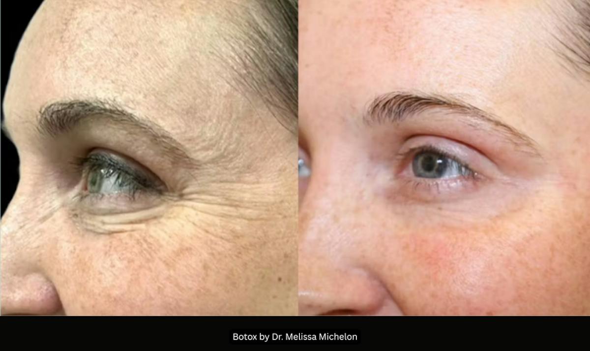 Michelon Non-surgical Before & After Gallery - Patient 249580 - Image 1