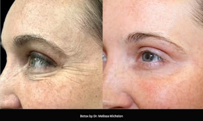 Michelon Non-surgical Before & After Gallery - Patient 249580 - Image 1