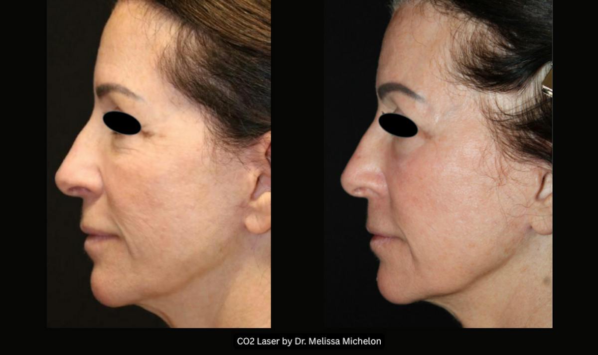 Michelon Non-surgical Before & After Gallery - Patient 162201 - Image 1