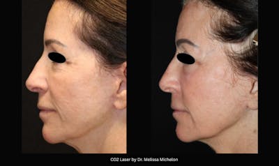 Michelon Non-surgical Before & After Gallery - Patient 162201 - Image 1