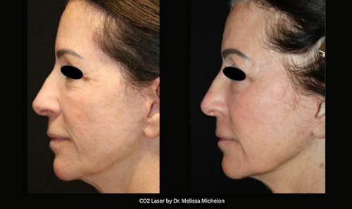 Before and after photos with Melissa Michelon, MD - patient 2 of 3