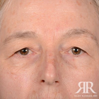 Eyelid Surgery Before & After Gallery - Patient 413553 - Image 1