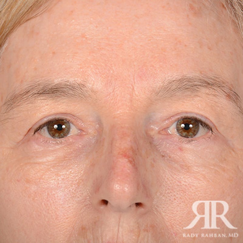 Before and after patient results