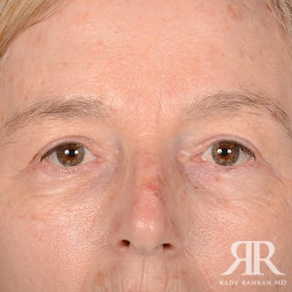 Eyelid Surgery Before & After Gallery - Patient 413553 - Image 2