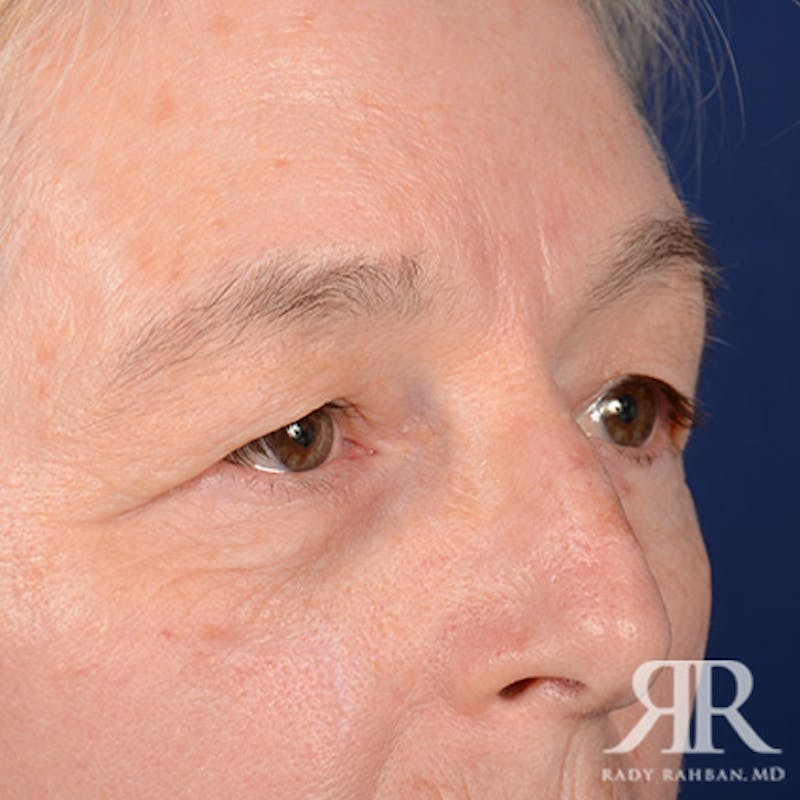 Eyelid Surgery Before & After Gallery - Patient 413553 - Image 3