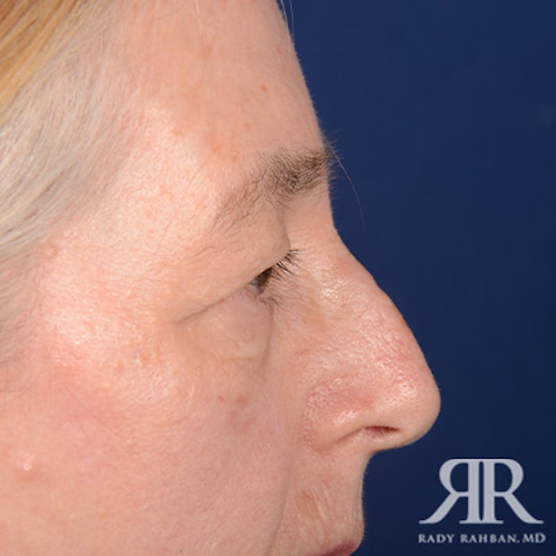 Eyelid Surgery Before & After Gallery - Patient 413553 - Image 5