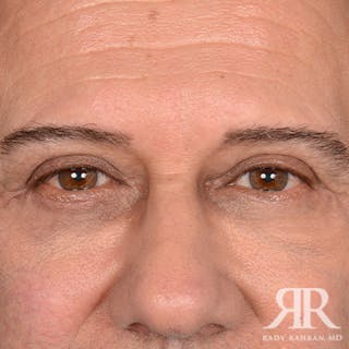 Eyelid Surgery Before & After Gallery - Patient 357162 - Image 2